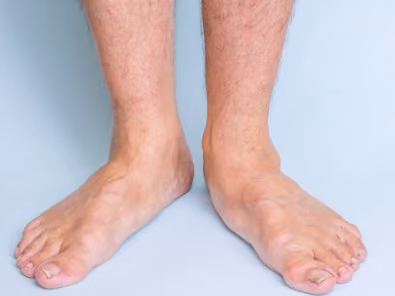 What’s the deal with flat feet?
